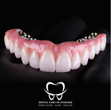 Hybrid Implant Bridge