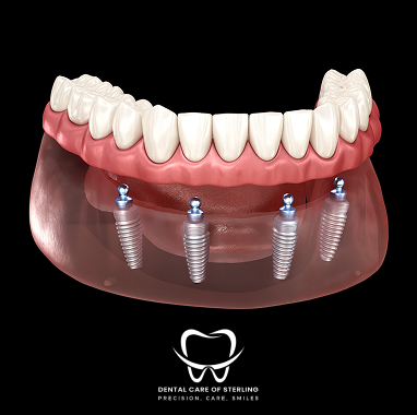 Zirconia Implant Bridge