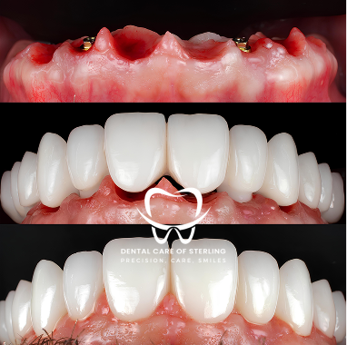 Porcelain Implant Bridge